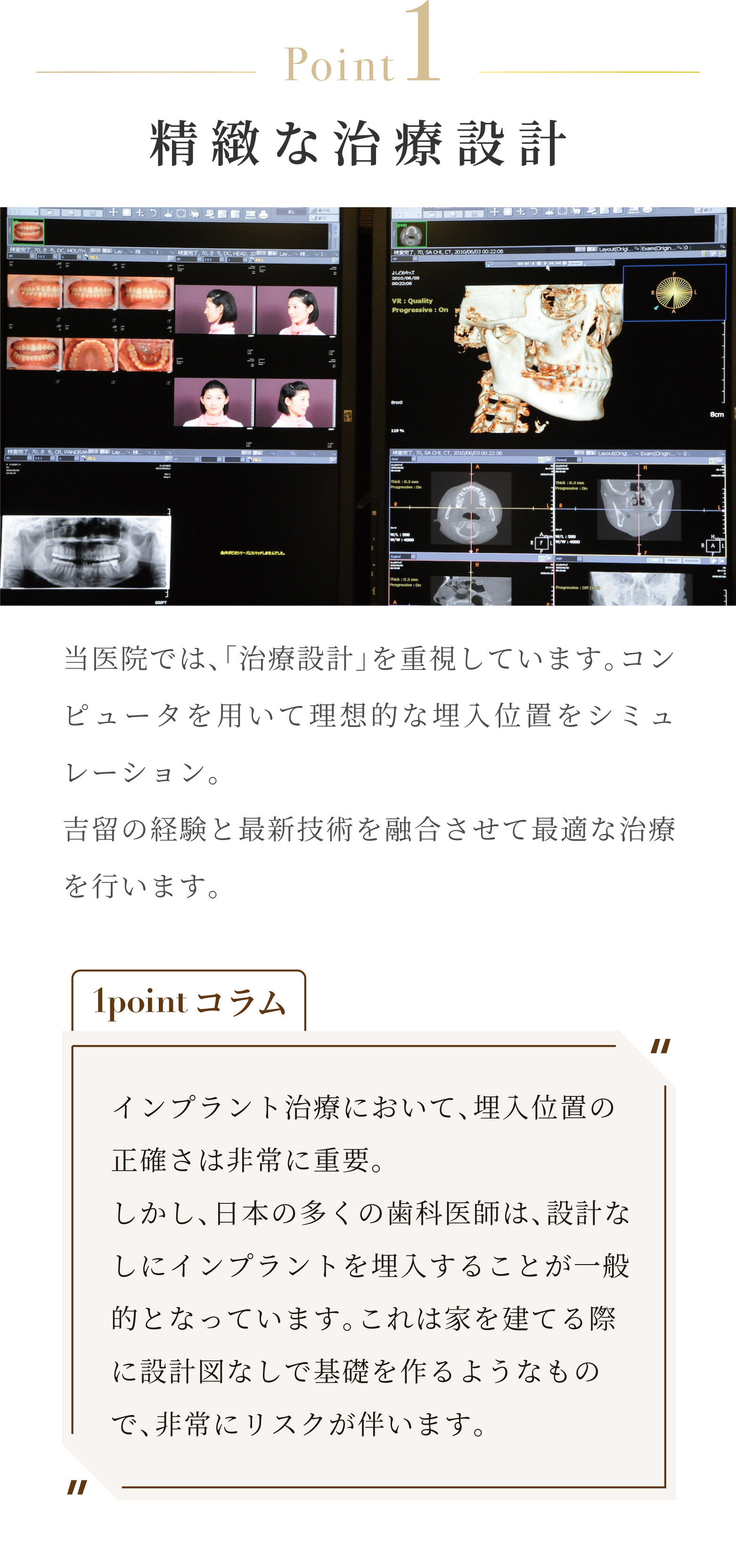 Point1 精緻な治療設計 当医院では、「治療設計」を重視しています。コンピュータを用いて理想的な埋入位置をシミュレーション。吉留の経験と最新技術を融合させて最適な治療を行います。1pointコラム インプラント治療において、埋入位置の正確さは非常に重要。しかし、日本の多くの歯科医師は、設計なしにインプラントを埋入することが一般的となっています。これは家を建てる際に設計図なしで基礎を作るようなもので、非常にリスクが伴います。