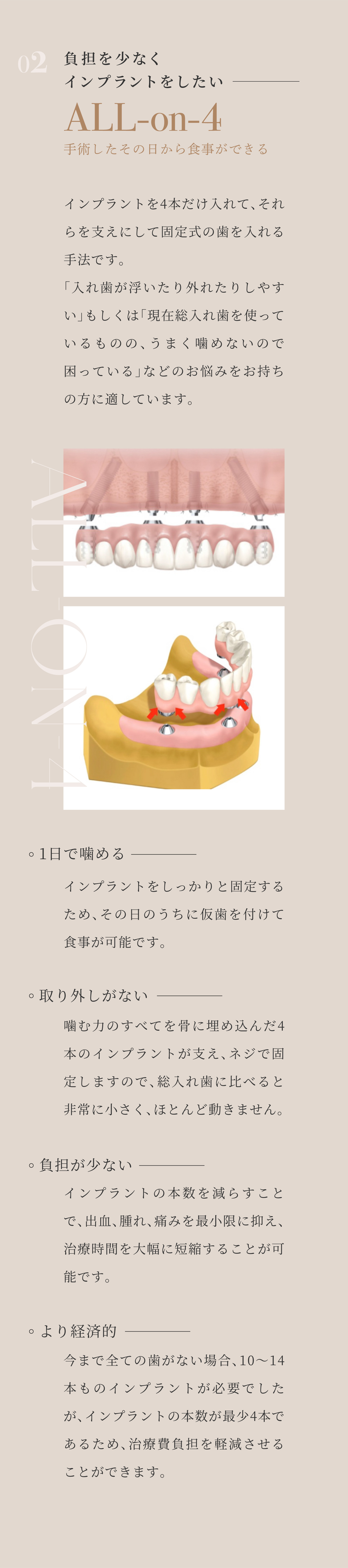 02 負担を少なくインプラントをしたい ALL-on-4 手術したその日から食事ができる インプラントを4本だけ入れて、それらを支えにして固定式の歯を入れる手法です。「入れ歯が浮いたり外れたりしやすい」もしくは「現在総入れ歯を使っているものの、うまく噛めないので困っている」などのお悩みをお持ちの方に適しています。1日で噛める インプラントをしっかりと固定するため、その日のうちに仮歯を付けて食事が可能です。取り外しがない 噛む力のすべてを骨に埋め込んだ4本のインプラントが支え、ネジで固定しますので、総入れ歯に比べると非常に小さく、ほとんど動きません。負担が少ない インプラントの本数を減らすことで、出血、腫れ、痛みを最小限に抑え、治療時間を大幅に短縮することが可能です。より経済的 今まで全ての歯がない場合、10～14本ものインプラントが必要でしたが、インプラントの本数が最少4本であるため、治療費負担を軽減させることができます。